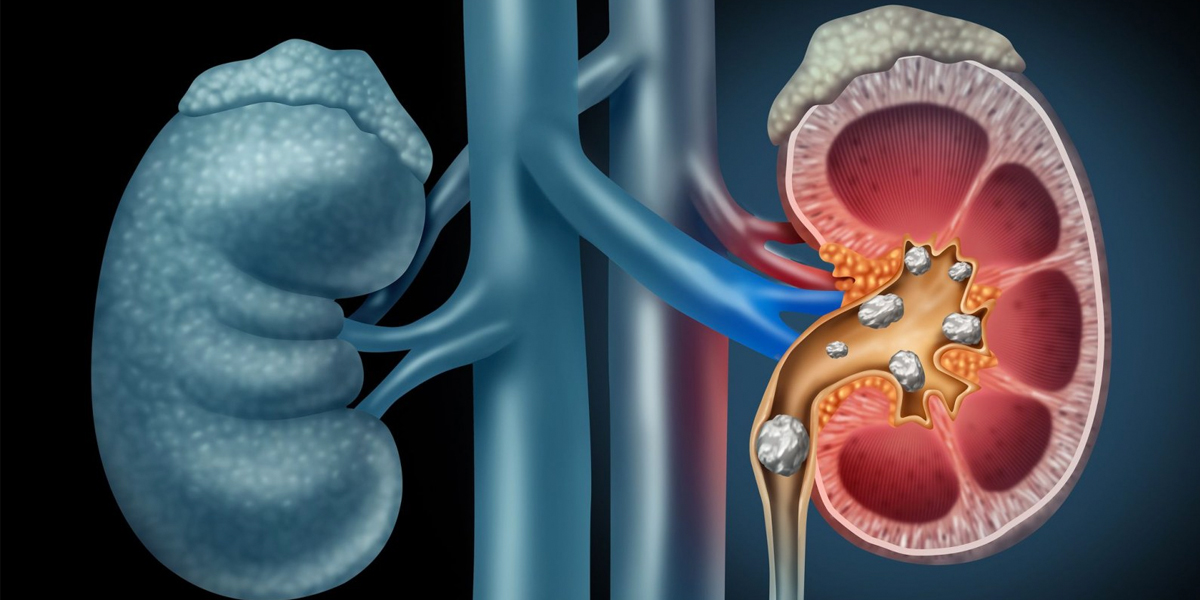 Kidney Stone Treatment & Surgery in Nagpur